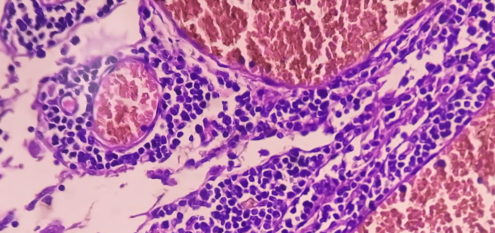 Após a aprovação do zolbetuximab na UE: Quando é que o medicamento estará disponível para os doentes?