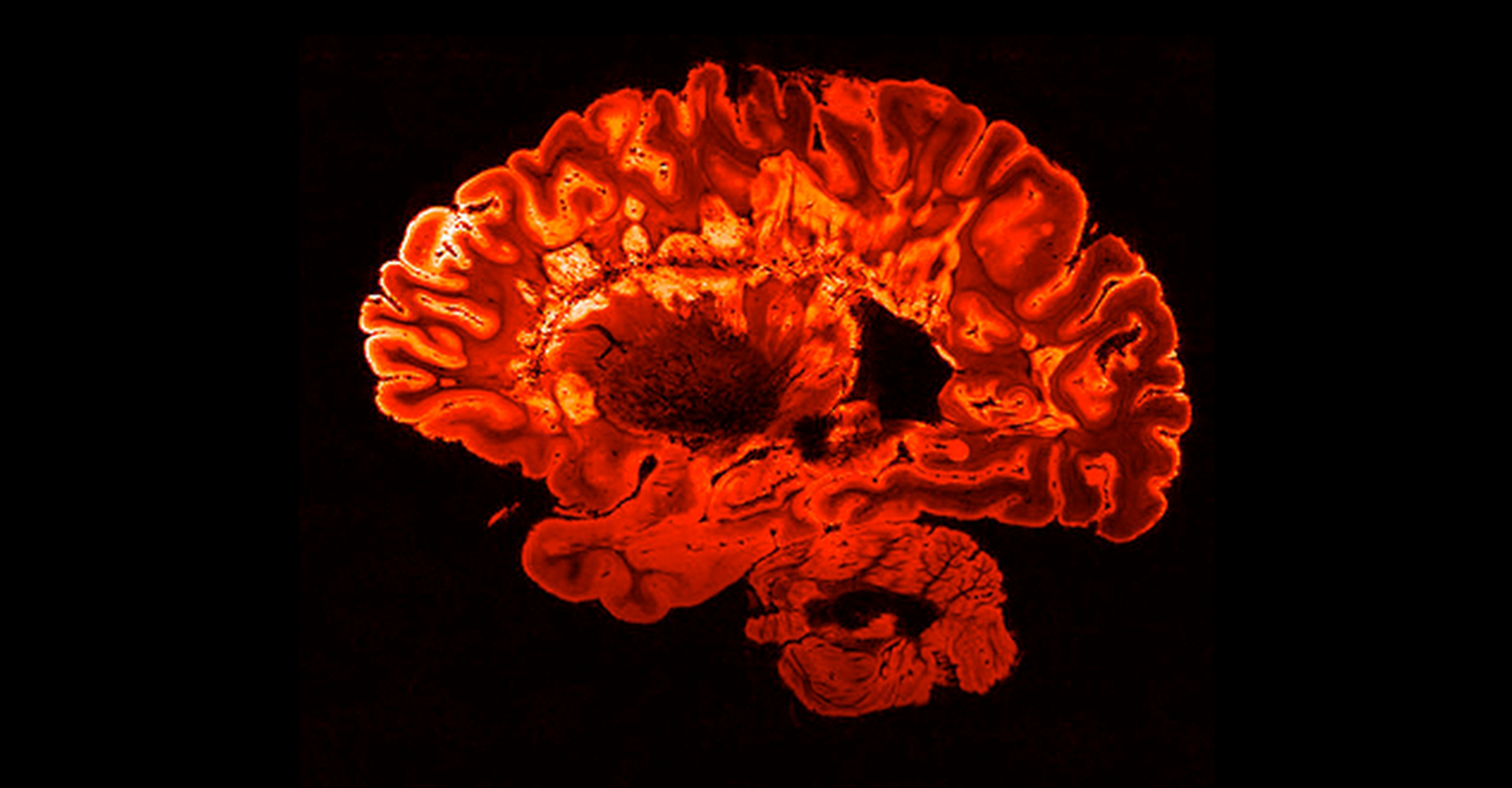 ressonância magnética cerebral vermelha